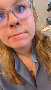 Favorite acne spot treatments? Preferably hormone acne