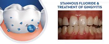 Gingivitis symptoms include painful gums, bleeding while brushing, red gums, swollen gums, tender gums, bad breath and bad taste in mouth. Crest Stannous Fluoride Anti Ginigivitis Activity Dentalcare