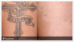 View more on why you should never attempt to perform tattoo removal on your own. Inkoff Hawaii Do It Yourself Tattoos Are A Risky Proposition