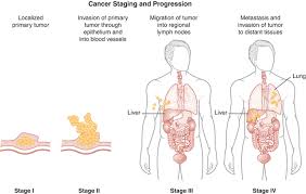 Image result for Primary Tumor Localization