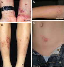 Image result for dermatitis contacta children