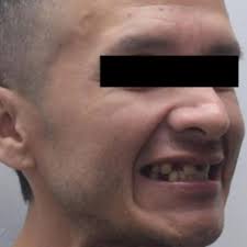 Caso de Rehabilitación Oral compleja combinado con ortodoncia inferior,  coronas, puentes fijos e implantes dentales, todo realizado en zirconio.  Dr. Paul Quintero Roman Esp. Rehabilitación Oral Esp. Implantes dentales  Quintero Especialidades Odontológicas,