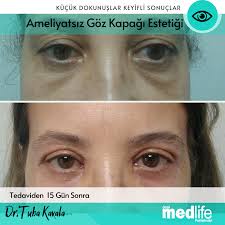 Goz Kapagi Estetigi 2020 Gozler Marmaris Estetik