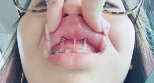 Wax works really well if braces is causing ulcers and cuts in your mouth. My Braces Story 3 Second And Final Stage Put On 4 Screws Chanwon Com Travel Beauty Blogger