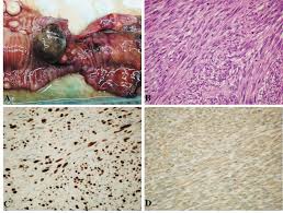 Image result for Leiomyosarcoma