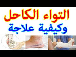 التواء الكاحل الاسباب الاعراض العلاج موضوع شامل Youtube