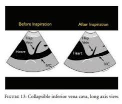We did not find results for: The Best Article On The Rush Ultrasound Exam For Medical Shock Tom Wade Md