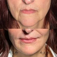 💉 Peri-Oral Rejuvenation + Lip Filler