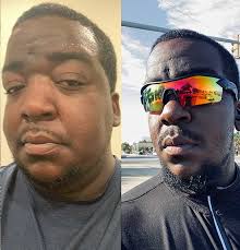 Expert Bariatric Revision Surgery at Renew Bariatrics