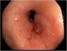 Image result for Radiation Colitis