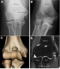 Image result for Elbow XRay