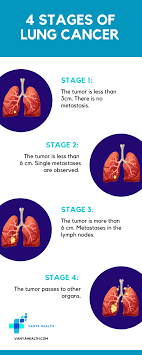 Sometimes these syndromes may be the first symptoms of lung cancer. 4 Stages Of Lung Cancer Album On Imgur