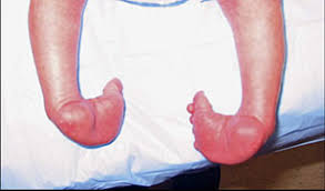 It was developed by ignacio v. Ponseti Method For Correcting Clubfoot Overview For Parents