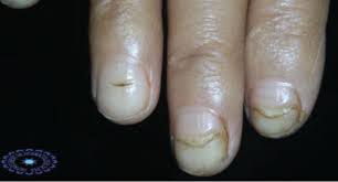 Introduction the worldwide prevalence of diabetes mellitus (dm). Nail Disorders In Patients With Chronic Renal Failure