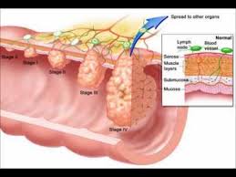 Omega 3 Omega 6 Polyunsaturated Fats Explained Very Quickly In Video Nutrition Explained Pinterest Cancer Colon Cancer And Cancer Treatment