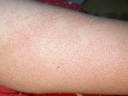 Piel De Gallina Podria Ser Queratosis Pilar Piel De Gallina Queratosis Piel