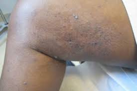 Lesions can occur singly, multiply in a limited area, or may be widespread. Kaposi Sarcoma After Lung Transplant Consult Qd