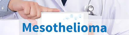 mesothelioma is a cancer that develops in these linings. Is Mesothelioma Hereditary