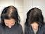 Iron Deficiency Hair Loss Regrowth