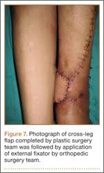 Image result for Crossed-Leg Test