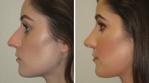 Some celebrities who undergo plastic surgery end up looking plasticky and artificial. The Best Before After Photos The Plastic Surgery Clinic