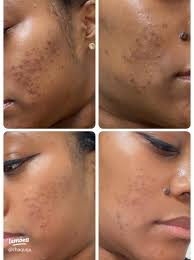 Transform Your Skin: Real Results from Tretinoin & Hydroquinone Use