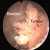 Bladder cancer most often begins in the cells (urothelial cells) that line the inside of your bladder. 1