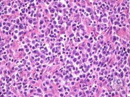 Новое в онкологии,сборник научных трудов под. Peripheral T Cell Lymphoma Nos 1