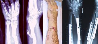 Dalam bahasa inggris, pernahkah kamu mendengar tentang clause? Bone Fracture Wikipedia