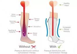 How Do Tight Stockings Prevent Deep Venous Thrombosis Quora