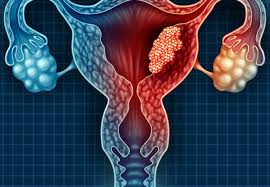 Cervical cancer occurs in the cells of the cervix (the neck of the womb), the lowest part of the uterus (womb) that connect the uterus with the vagina. A Guide On Cervical Cancer And Its Treatment From Delhi Cancer Hospital