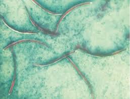 People who are immunocompromised have a reduced ability to fight infections and other diseases. Disseminated Strongyloidiasis In An Immunocompromised Host A Case Report Sciencedirect