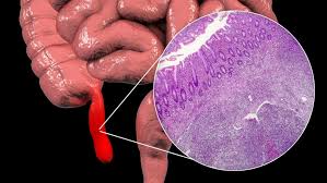 Maybe you would like to learn more about one of these? Punca Apendiks Adakah Biji Cili Salah Satu Daripadanya Hello Doktor