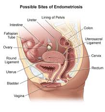 257 female body diagram stock illustrations and clipart. Endometriosis Johns Hopkins Medicine