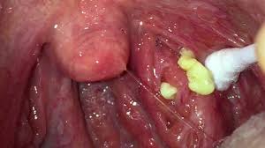 Gargle this mixture in your mouth for some minutes and avoid swallowing this. Tonsil Stone Removal Videos Are Taking Over The Internet Allure