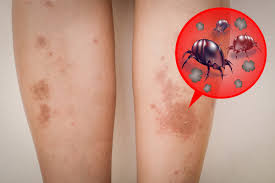 Image result for Dust mite