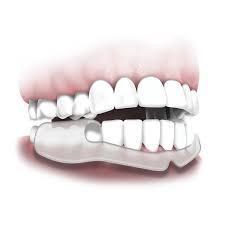 It can be molded to the top or bottom teeth. Dental Night Guard Night Guard For Teeth Grinding Clenching Plackers
