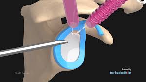 Image result for SLAP Lesion