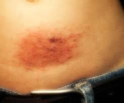 Se hai intossicazione alimentare, ti starai chiedendo quando ti sentirai meglio. Allergia Al Nichel Solfato Sintomi E Diagnosi Allergologo Net