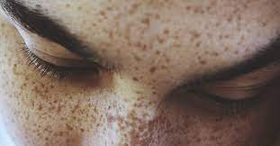 How To Get Rid Of Freckles: 7 Ways