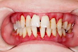Image result for Periodontitis