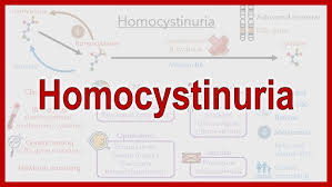Image result for Homocystinuria