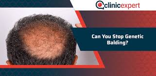 Your hair will probably most likely keep on shedding until you're almost totally bald. Can You Stop Genetic Balding Clinicexpert International Hair Transplant Plastic Surgery