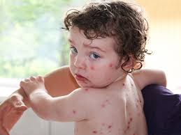 Image result for shingles in children
