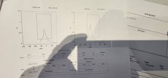 Image result for Inner Ear Decompression Sickness