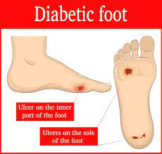 We did not find results for: 10 Tips For Diabetic Foot Care Ck Birla Hospitals Rbh Jaipur