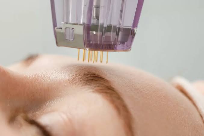 Maximise Your Morpheus8 Results: Post-Treatment Care and Skincare Tips