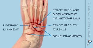 Indirect injury twisting injuries lead to forceful abduction of the forefoot, often resulting in a 2nd metatarsal base fracture and/or compression. What Are Lisfranc Injuries Mass4d Foot Orthotics