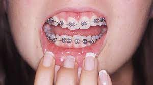 How to get braces for free or an affordable price. Adult Braces Why Are More Grown Ups Getting Their Teeth Straightened Bbc News