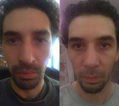 Mal au nez comme si j'avais pris un coup. Gonflement Apres Une Rhino Rhinoplastie Chirurgie Du Nez Forum Estheticon Fr